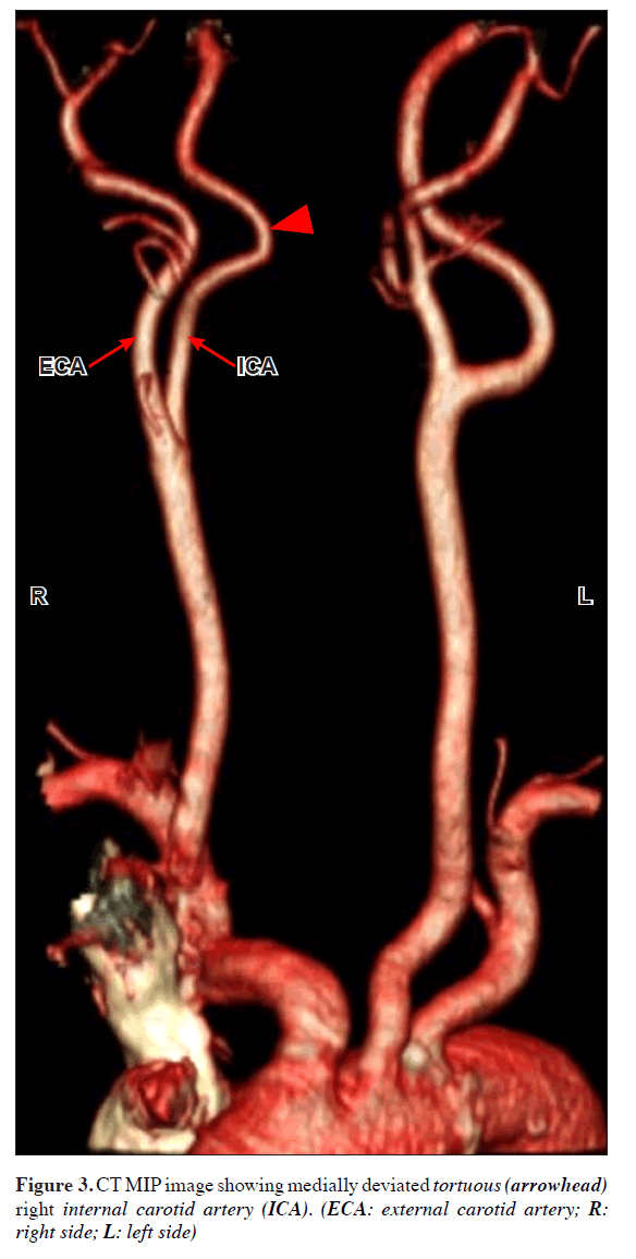 anatomical-variations-medially-deviated