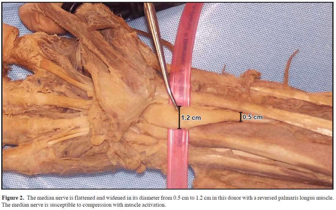 anatomical-variations-median-nerve