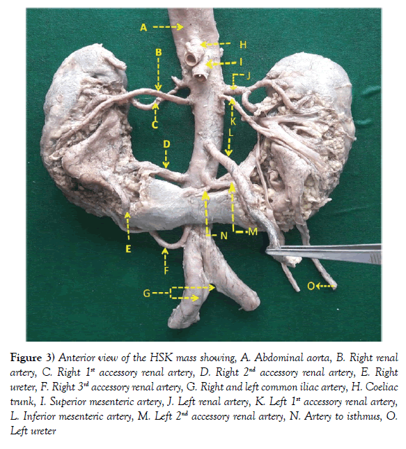 anatomical-variations-mesenteric-artery