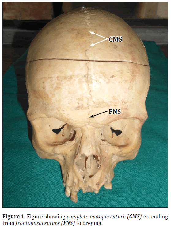 anatomical-variations-metopic-suture