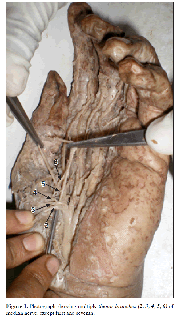 anatomical-variations-multiple-thenar