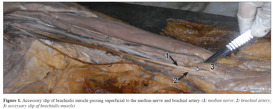 anatomical-variations-muscle