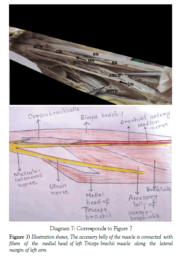 anatomical-variations-muscle-connected