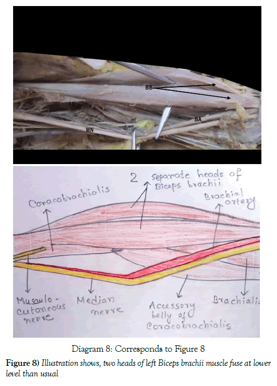 anatomical-variations-muscle-fuse