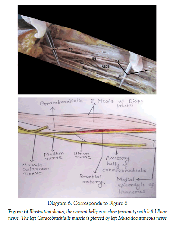 anatomical-variations-muscle-pierced