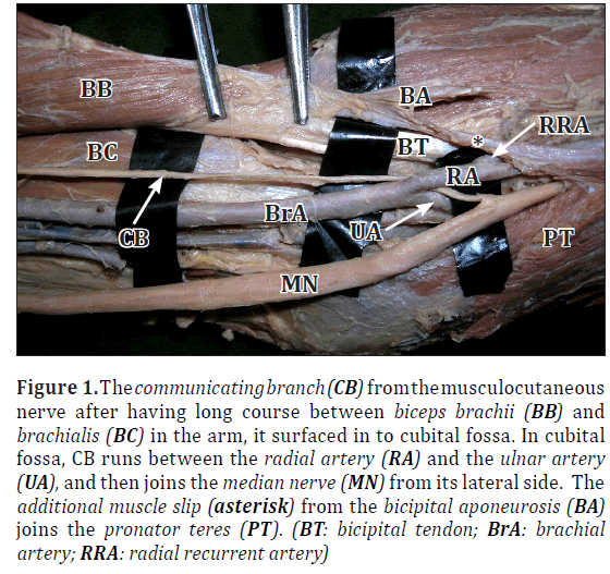 anatomical-variations-muscle-slip