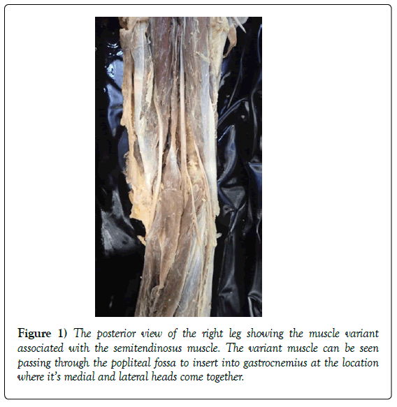 anatomical-variations-muscle-variant