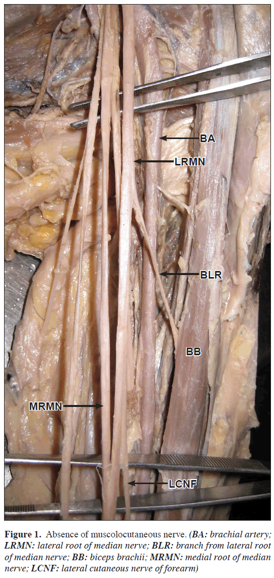 anatomical-variations-muscolocutaneous-nerve