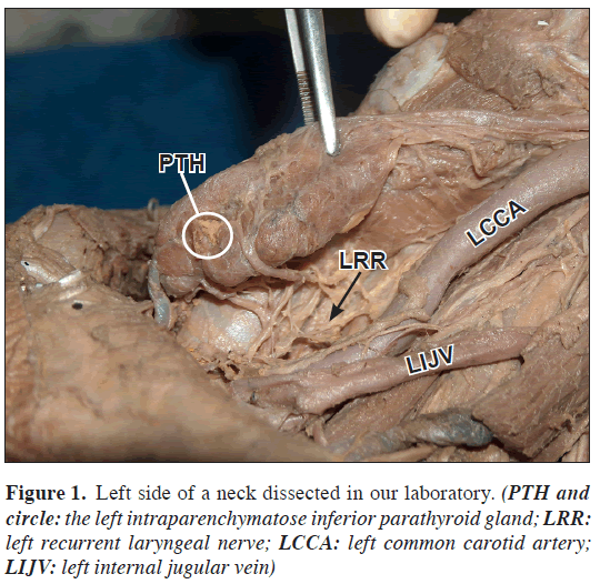 anatomical-variations-neck-dissected