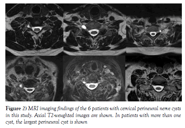 High prevalence of cervical perineural cysts on cervical spine MRI-Case