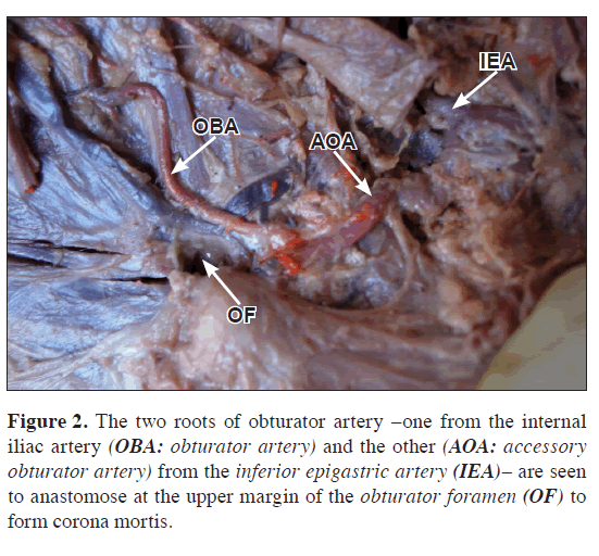anatomical-variations-obturator-artery