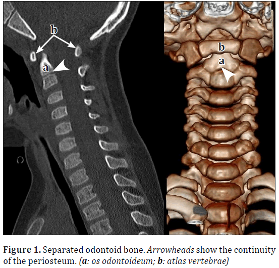 anatomical-variations-odontoid-bone