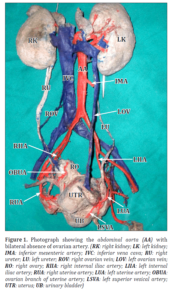anatomical-variations-ovarian-artery