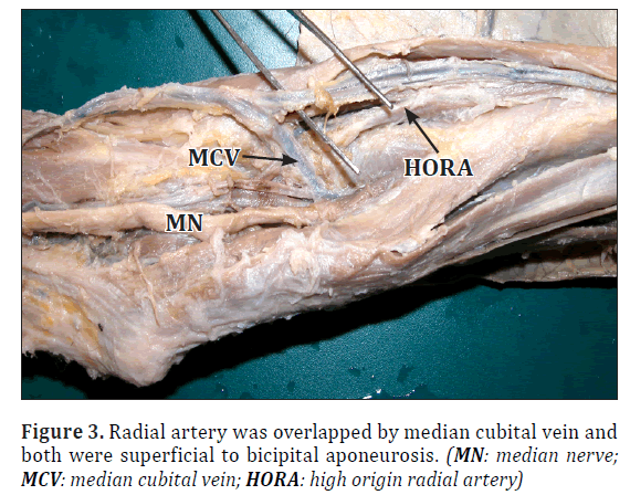 anatomical-variations-overlapped-median