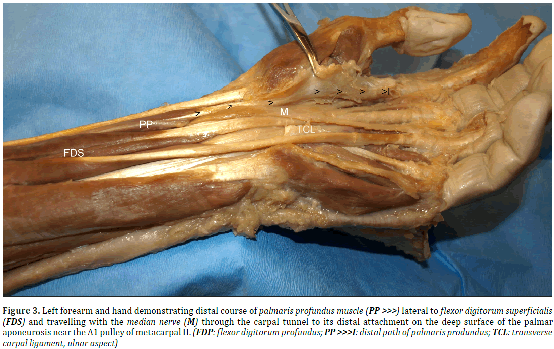 anatomical-variations-palmar-aponeurosis