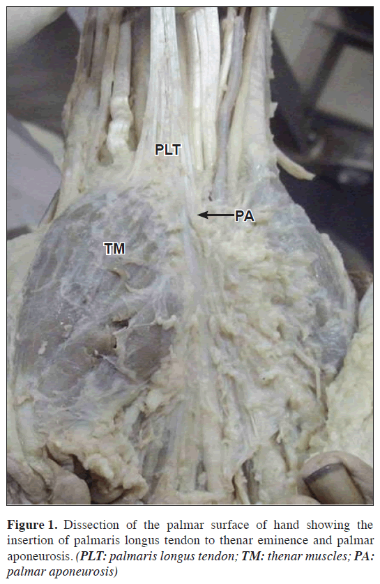anatomical-variations-palmar-surface