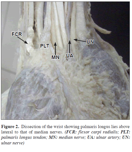 anatomical-variations-palmaris-longus