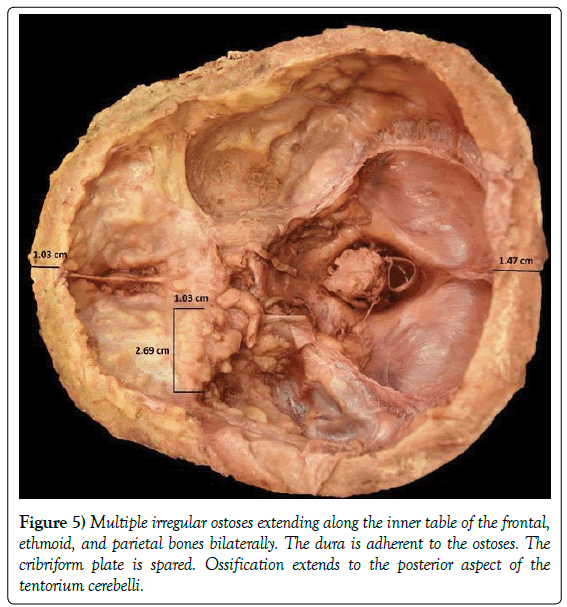 anatomical-variations-parietal-bones