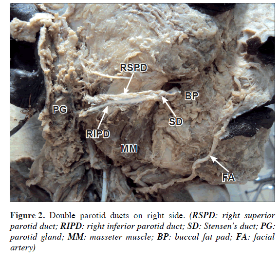 anatomical-variations-parotid-ducts