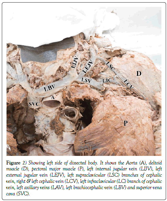 anatomical-variations-pectoral-major