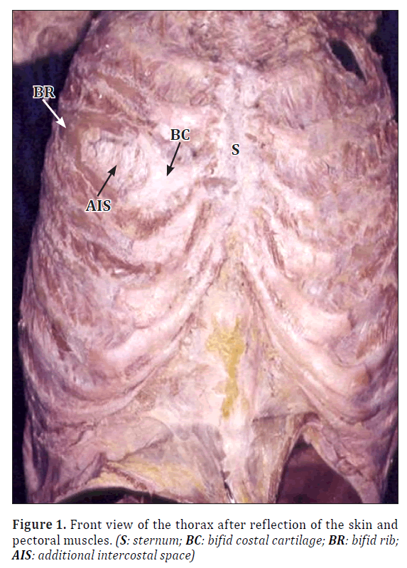 anatomical-variations-pectoral-muscles