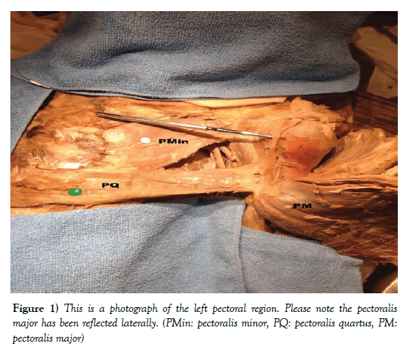 anatomical-variations-pectoral-region