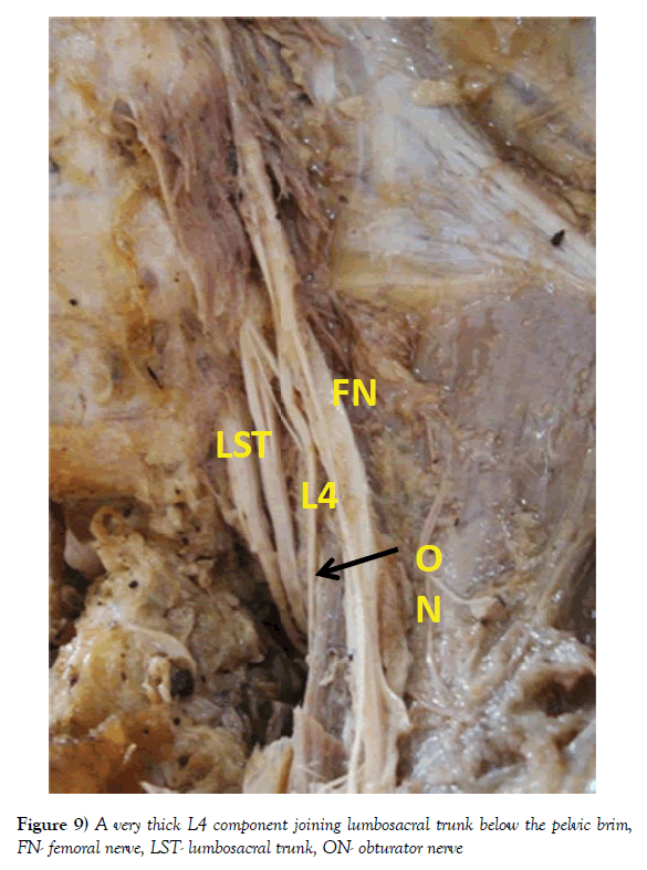 anatomical-variations-pelvic-brim
