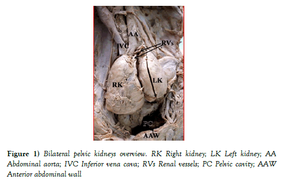 anatomical-variations-pelvic-kidneys
