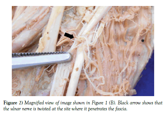 anatomical-variations-penetrates-fascia