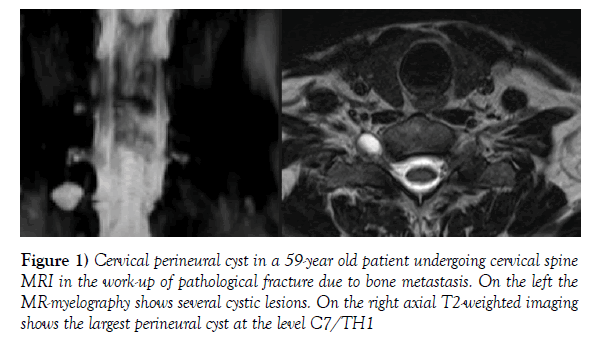 anatomical-variations-perineural-cyst