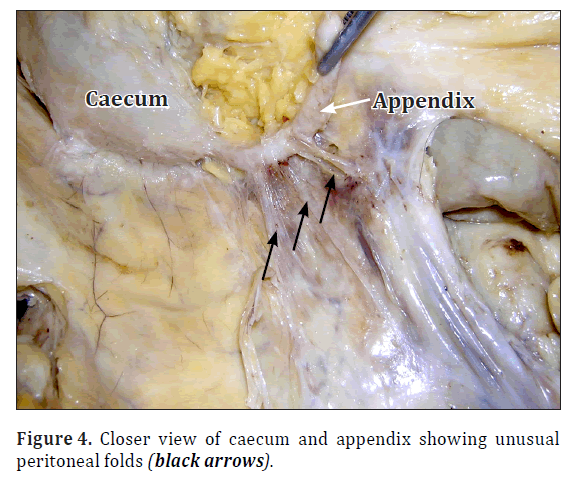 anatomical-variations-peritoneal-folds