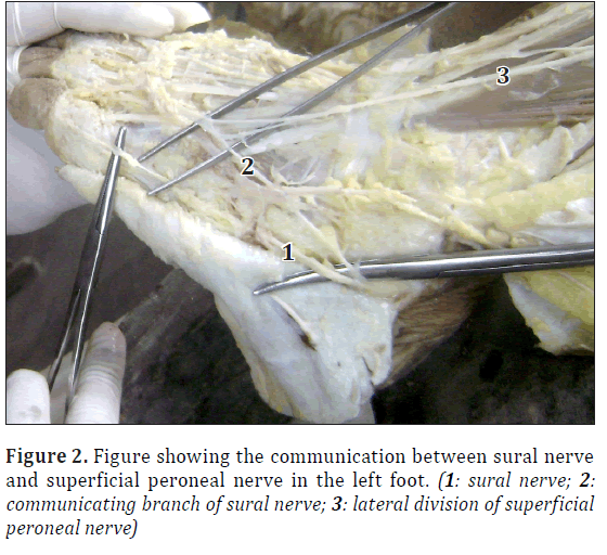 anatomical-variations-peroneal-nerve