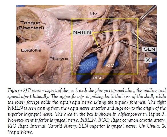 anatomical-variations-pharynx-forceps