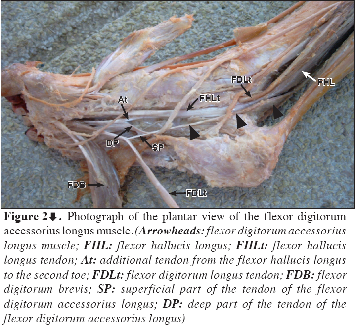 anatomical-variations-plantar-view