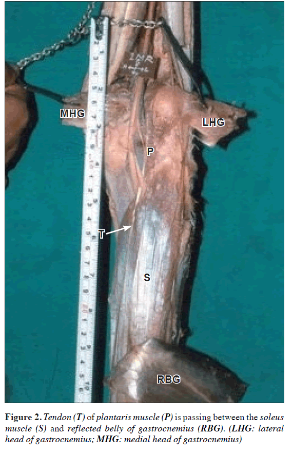 anatomical-variations-plantaris-muscle