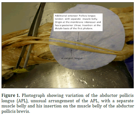 anatomical-variations-pollicis-longus