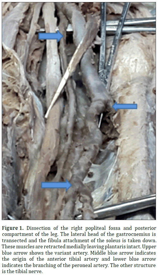 anatomical-variations-popliteal-fossa