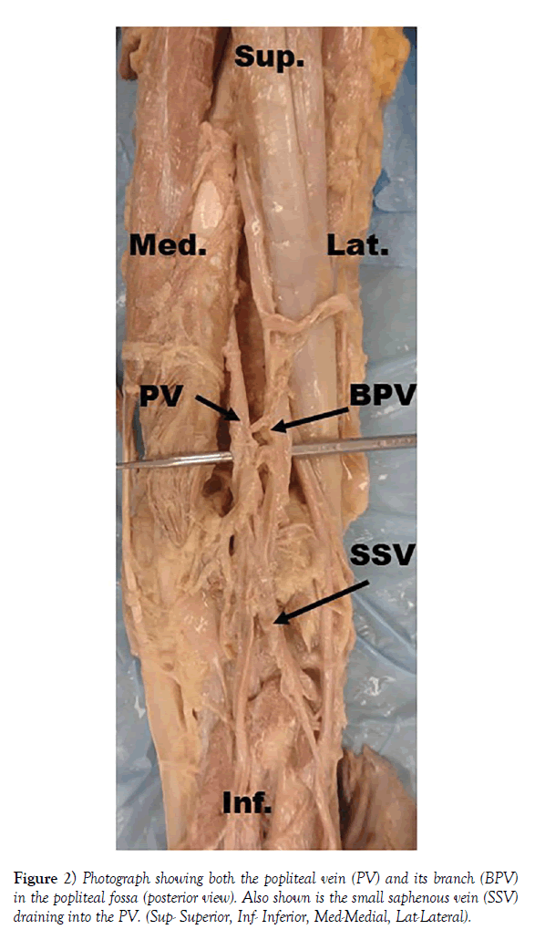 anatomical-variations-popliteal-vein