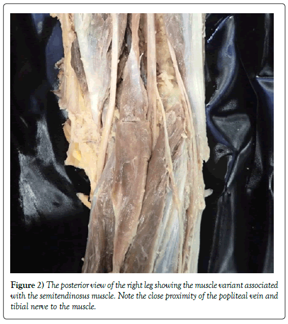 anatomical-variations-popliteal-vein