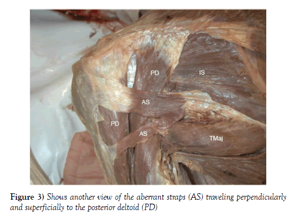 anatomical-variations-posterior-deltoid