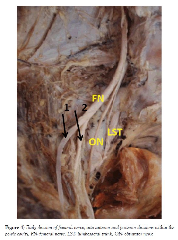 anatomical-variations-posterior-divisions