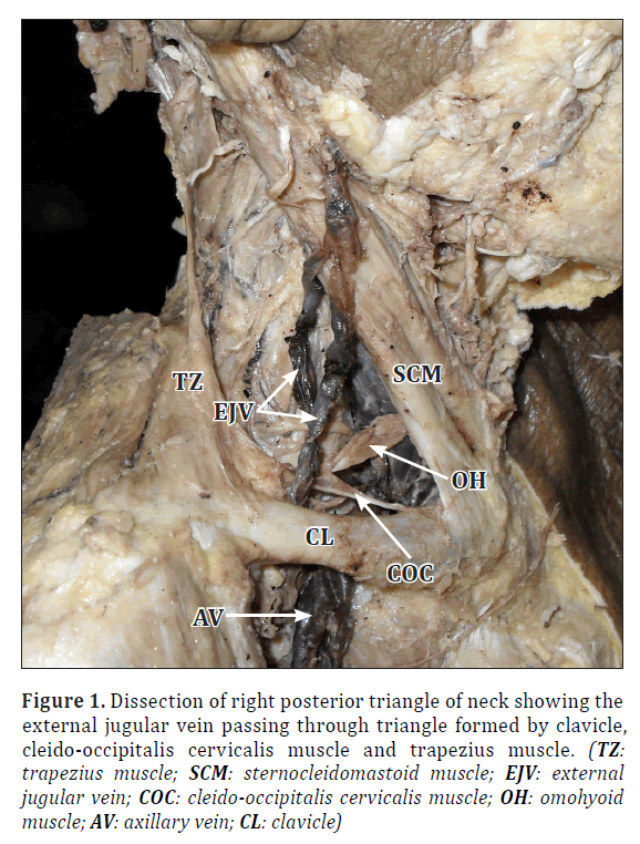 anatomical-variations-posterior-triangle