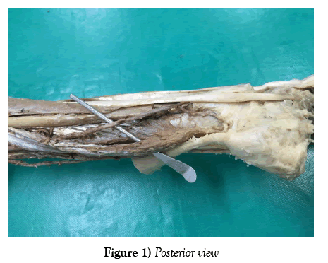 anatomical-variations-posterior-view