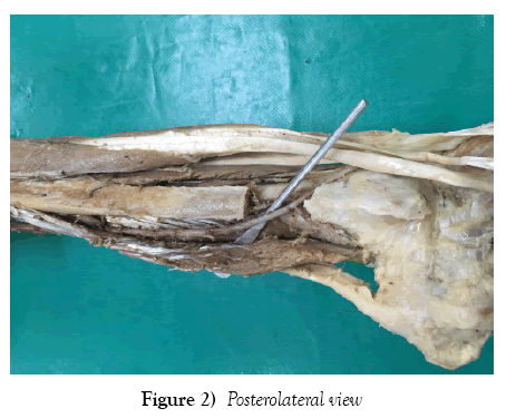 anatomical-variations-posterolateral-view