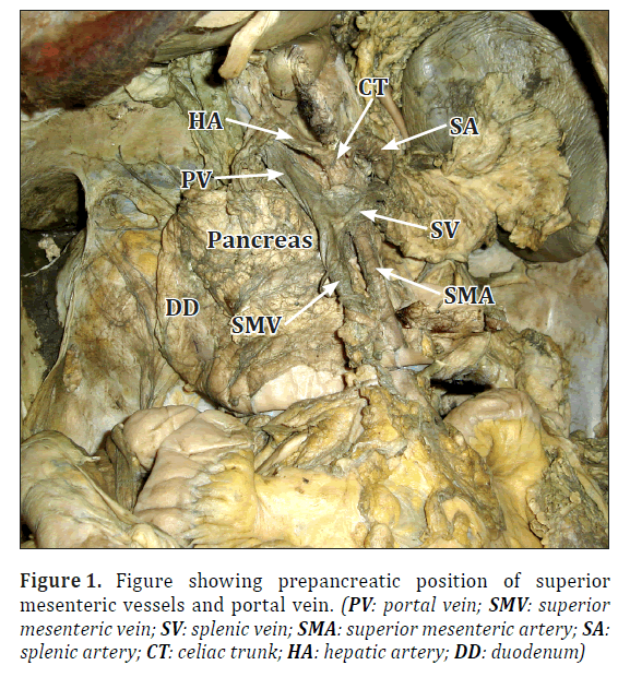 anatomical-variations-prepancreatic-position