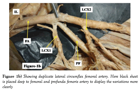 anatomical-variations-profunda-femoris