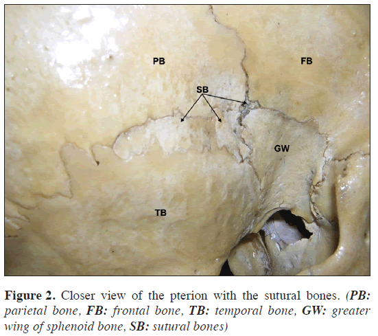 anatomical-variations-pterion