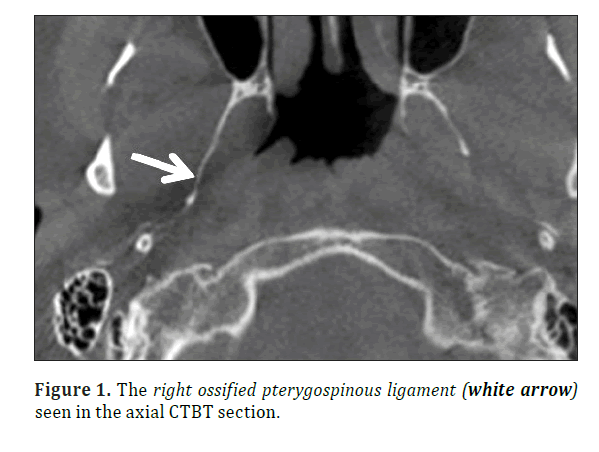 anatomical-variations-pterygospinous-ligament