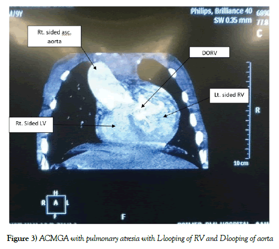 anatomical-variations-pulmonary-atresia