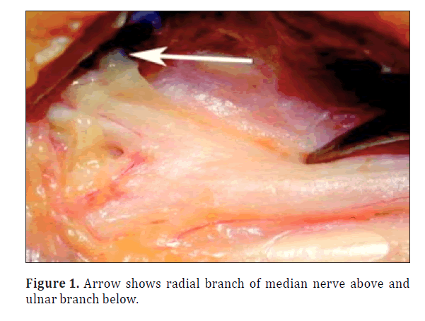 anatomical-variations-radial-branch